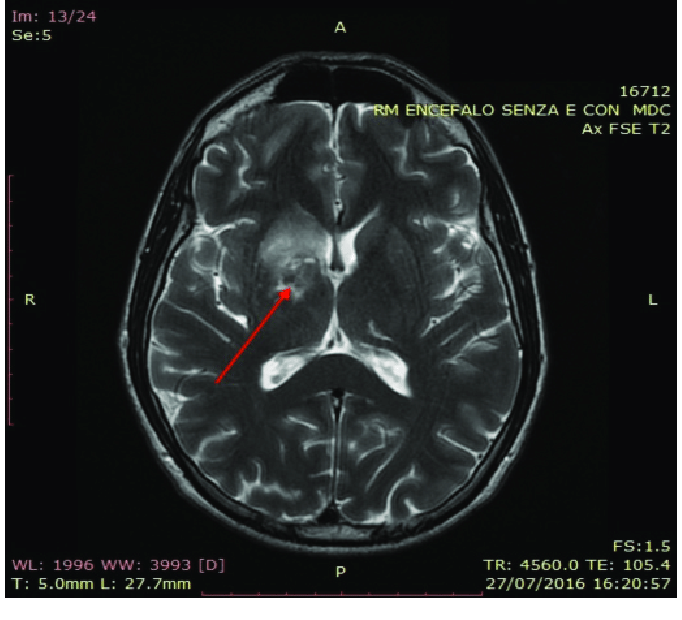 Questa immagine ha l'attributo alt vuoto; il nome del file è Brain-MRI-T2-weighted-sequence-The-arrows-point-to-n-hyperintensity-area-mainly.png